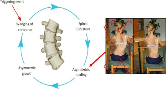 A bal oldali képen: Az ördögi kör. Dr. Stokes és Burwell feltevése szerint a skoliózisgörbe progressziójának ördögi ciklusa egy kiváltó eseménnyel kezdődik, amely az ékcsigolyák kialakulásához vezet. Az ékcsigolyák a gerinc görbülését okozzák, ami a gerinc folyamatos aszimmetrikus terhelését eredményezi. Ez viszont potenciálisan elősegítheti a gerinc aszimmetrikus növekedését és a skoliózisgörbék progresszióját, mivel az aszimmetrikus növekedés fokozza a csigolyák beékelődését, és a körforgás tovább folytatódik. A jobb oldali kép egy skoliózisos beteget mutat, aki a gerinc fokozott aszimmetrikus terhelésével ül, ahogyan azt Stokes "Ördögi kör" című művében leírták. A képen látható nagy piros "X" jelzi, hogy ez nem a kívánt testtartás. A jobb oldali kép ugyanezt a skoliózisos beteget mutatja, amint a gerinc jobb aszimmetrikus terhelése mellett ül, miközben a Lyon-féle megközelítésnek megfelelően skoliózis-specifikus fizioterápiás gyakorlatokat végez.