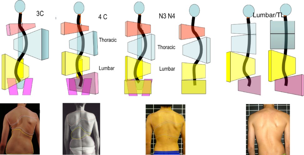 A skoliózis görbék osztályozásának BSPTS rendszere fényképekkel és testblokkdiagramokkal illusztrálva.