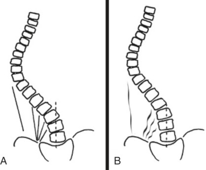 A korrekciós elmozdulás a frontális síkban nehezebb, ha a korrekciós elmozdulást korlátozó myofasciális struktúrák korlátozzák. Az ábra a terápia előtti (a) és a myofasciális terápia utáni (b) állapotot mutatja. 