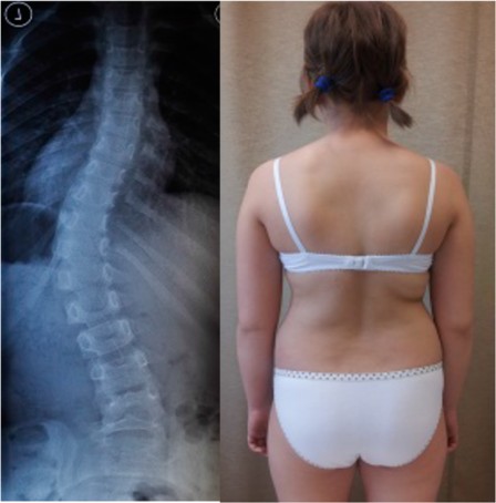 Egy 12 éves, bal mellkasi gerincferdülésben szenvedő lány fizikai megjelenése és esztétikája javult a merevítéssel és a FITS-módszerrel történő kezelés után. 