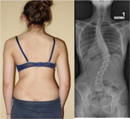 Egy 15 éves nőbeteg, akinek a jobb oldali röntgenfelvételen látható 32°-os Cobb-szögű bal felső mellkasi görbülete és 36°-os Cobb-szögű jobb mellkas- és ágyéki görbülete van, a FITS-terápia hatására javult a fizikai megjelenése és az esztétikája.